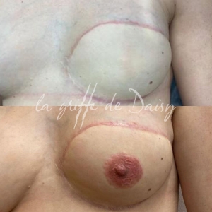 pigmentation-seins-03